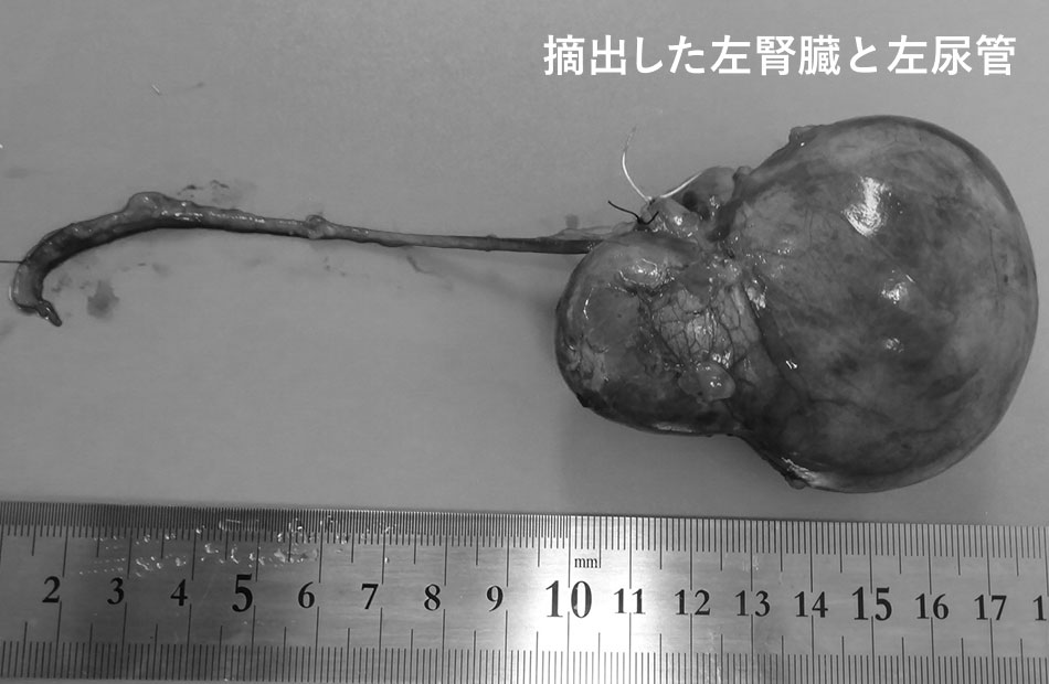 摘出した左腎臓と左尿管