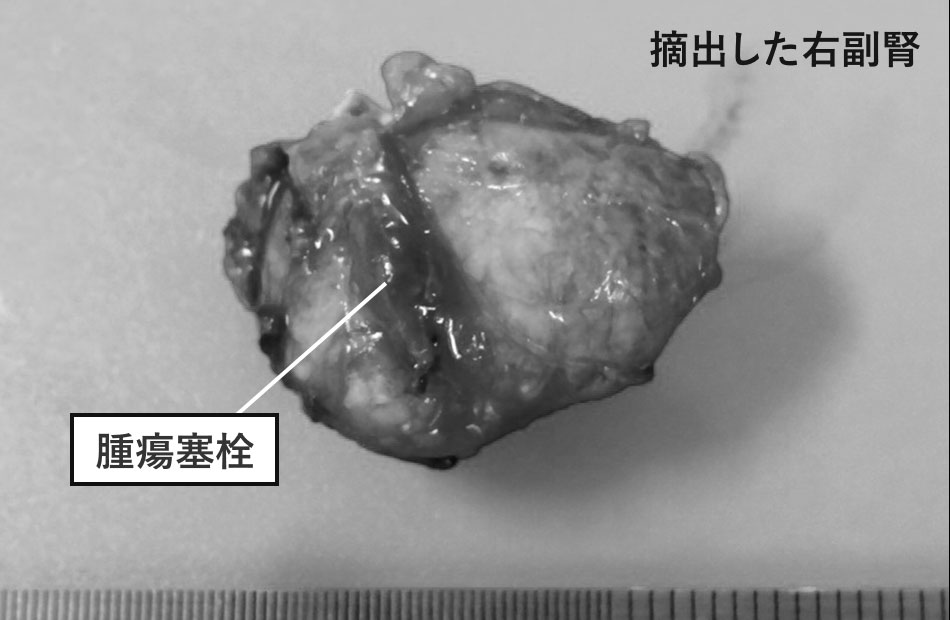 摘出した右副腎