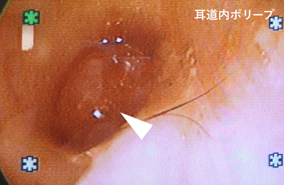 耳道内ポリープ