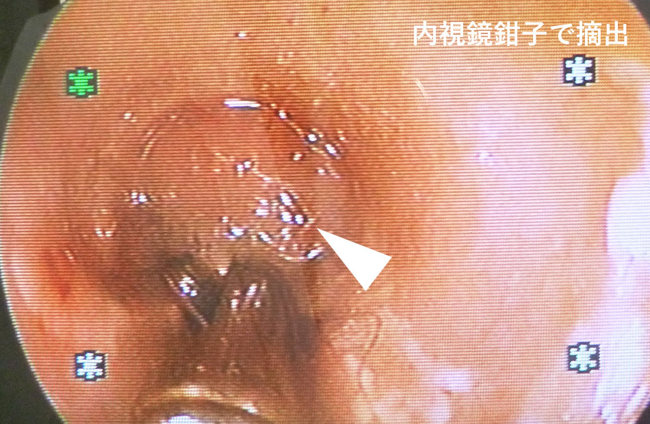 内視鏡鉗子で摘出