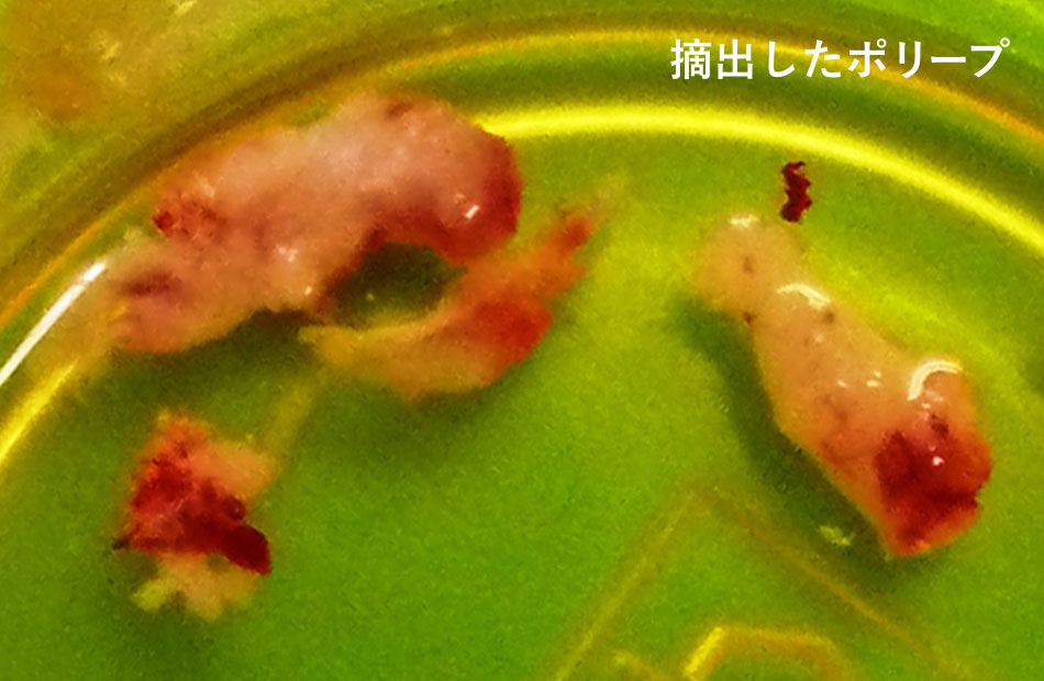 摘出したポリープ